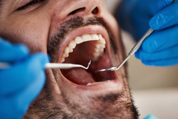 Best Emergency Dental Extractions in Keene, TX