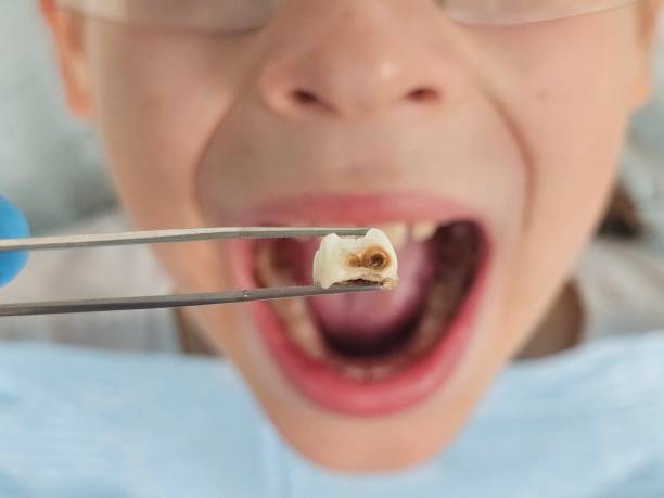 Best Emergency Dentist for Lost Fillings or Crowns in Keene, TX